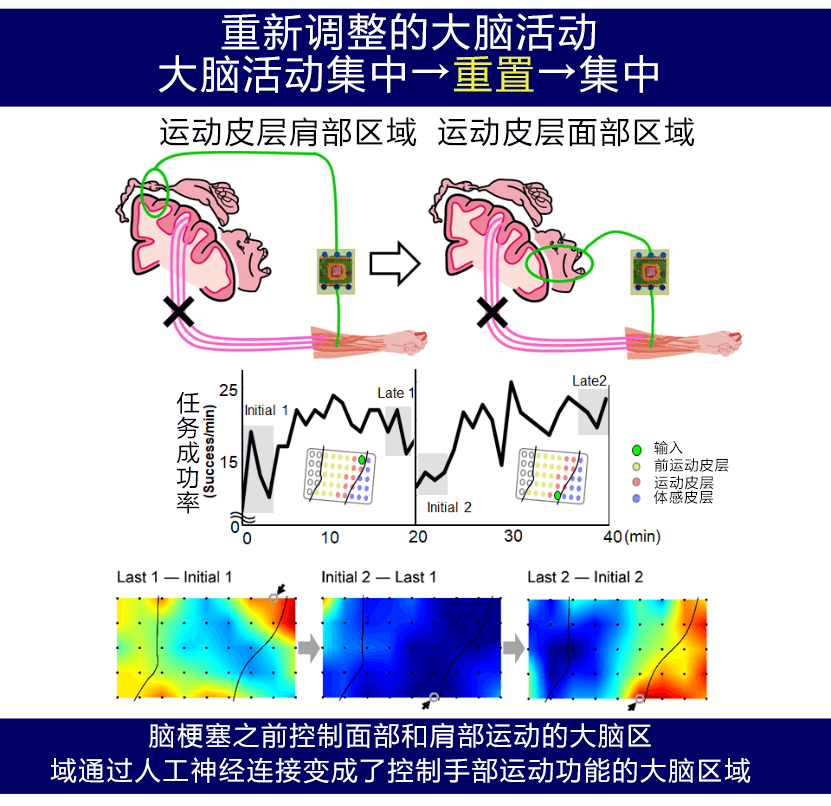 人工神经连接系统让脑梗塞患者重拾手部运动功能