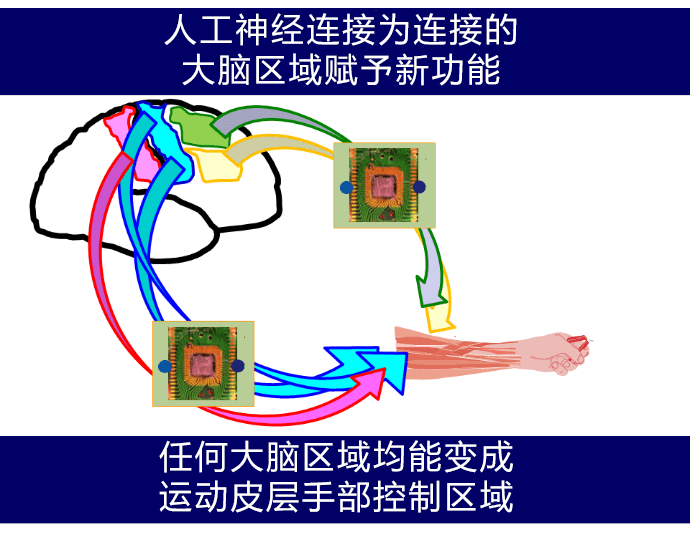 人工神经连接系统让脑梗塞患者重拾手部运动功能