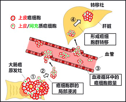日本查明大肠癌的新转移机制,将开发以癌细胞群为靶点的大肠癌转移抑制疗法