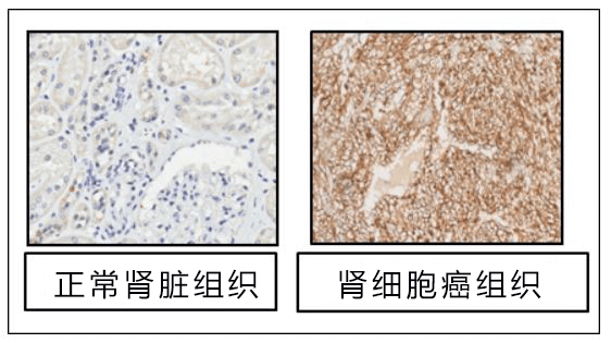 千叶大学发现肾癌新靶点，助力新药开发