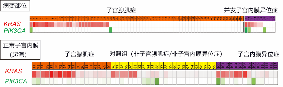 日本发现导致子宫腺肌症发病及并发子宫内膜异位症的基因突变