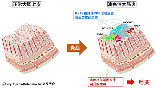 日本查清溃疡性大肠炎的上皮重塑机制与癌变的关系