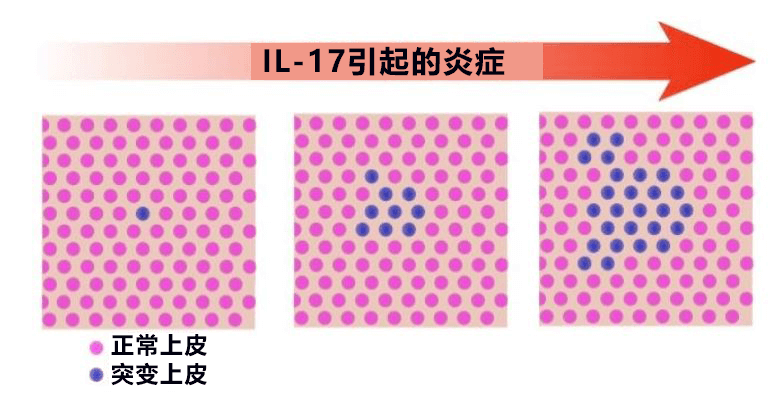 日本发现溃疡性大肠炎特定基因突变，有望查清发病和恶化机制