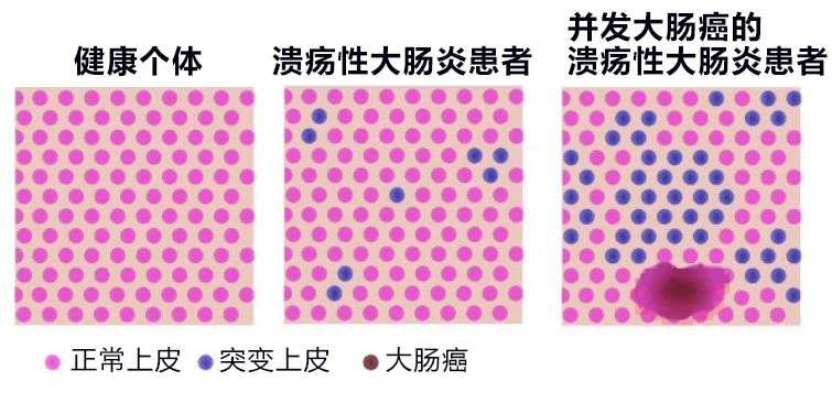 日本发现溃疡性大肠炎特定基因突变，有望查清发病和恶化机制