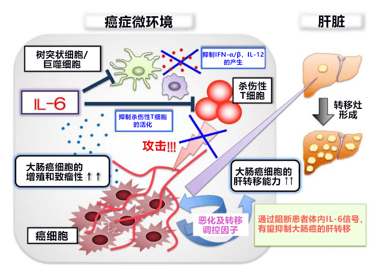 日本查清促进大肠癌肝转移的新控制机制，阻断IL-6信号有望抑制转移