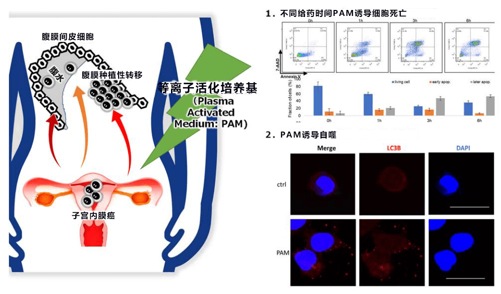 开拓子宫内膜癌治疗的新思路――等离子抗肿瘤的效果和机理