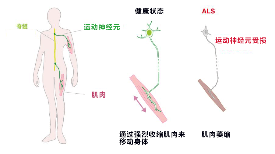 用光照射再现渐冻症,有望查清发病机制并开发新药