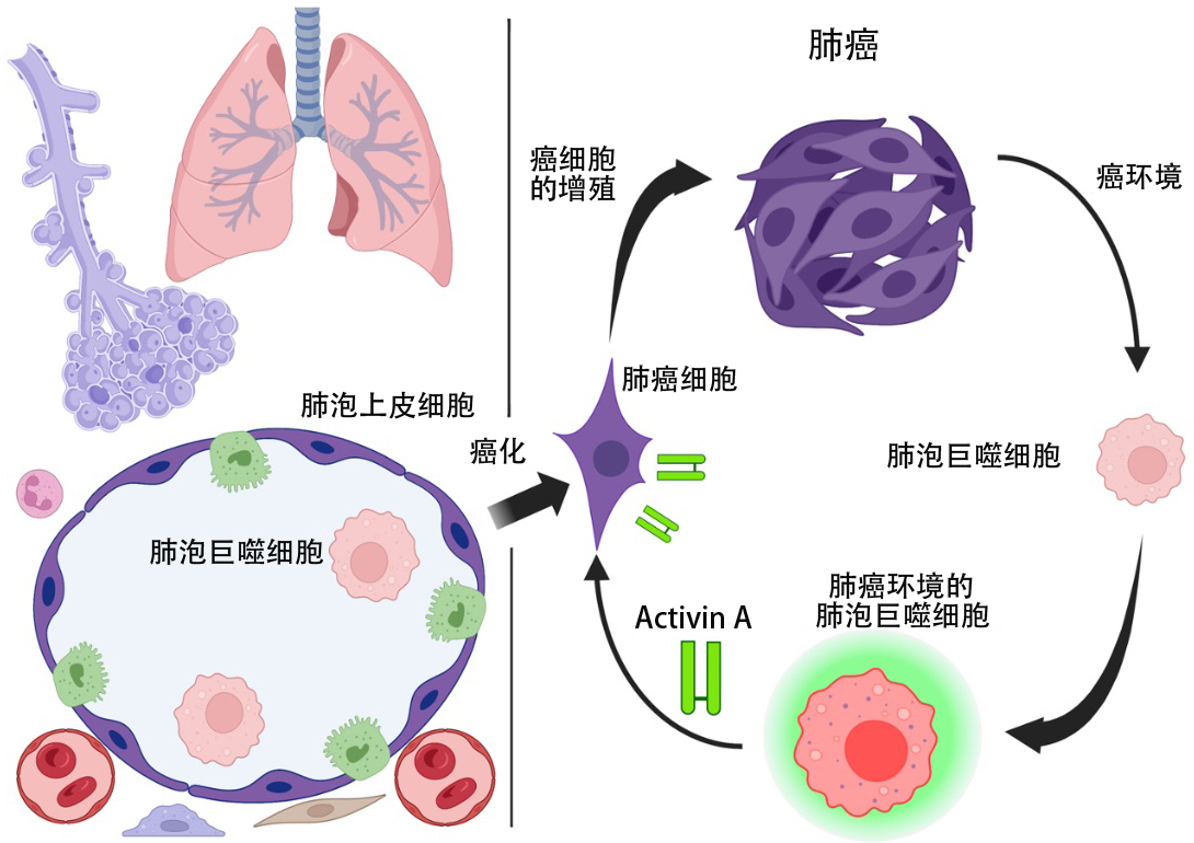 病例136 细支气管肺泡细胞癌-特种医学-医学