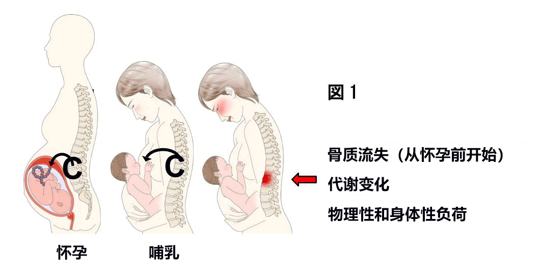 孕前检查骨密度,有益于预防产后骨质疏松和椎体骨折